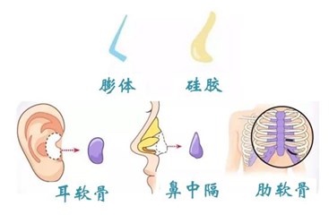 隆鼻，合理利用隆鼻材料特性，实现安全塑美才是王道