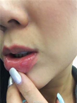 陈浩民与妻子吃面包烫伤 紧急乘救护车就医